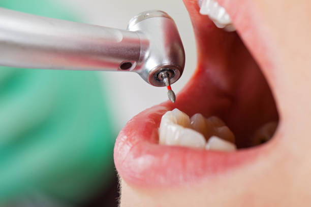 Best Emergency Tooth Extraction in Mcmurray, PA